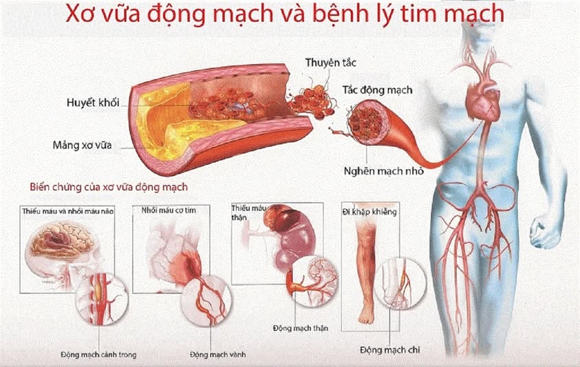 TIỂU ĐƯỜNG KÈM MỠ MÁU CAO – NGUY CƠ TĂNG GẤP NHIỀU LẦN 4 612751775 1741627550527501 3725281902883256624 n