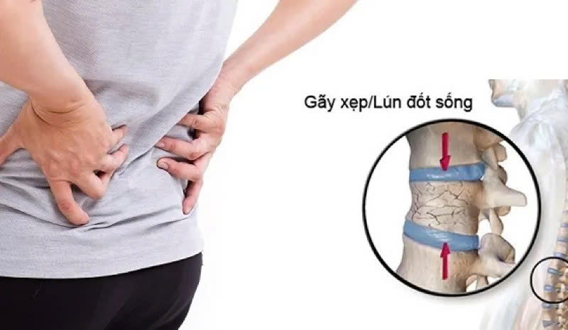 XẸP CẤP THÂN ĐỐT SỐNG – ĐỪNG CHỦ QUAN 2 622076712 1757415722282017 5699321534626782774 n 1
